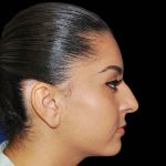 Rhinoplasty Before & After Patient #16988