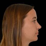 Rhinoplasty Before & After Patient #16995