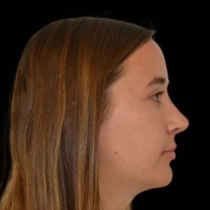 Rhinoplasty Before & After Patient #16995