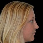 Rhinoplasty Before & After Patient #17002