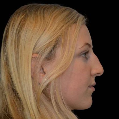 Rhinoplasty Before & After Patient #17002