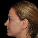 Rhinoplasty Before & After Patient #17009