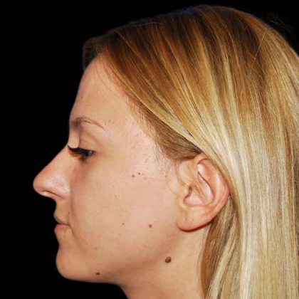 Rhinoplasty Before & After Patient #17009