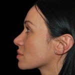 Rhinoplasty Before & After Patient #17017
