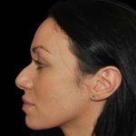 Rhinoplasty Before & After Patient #17017