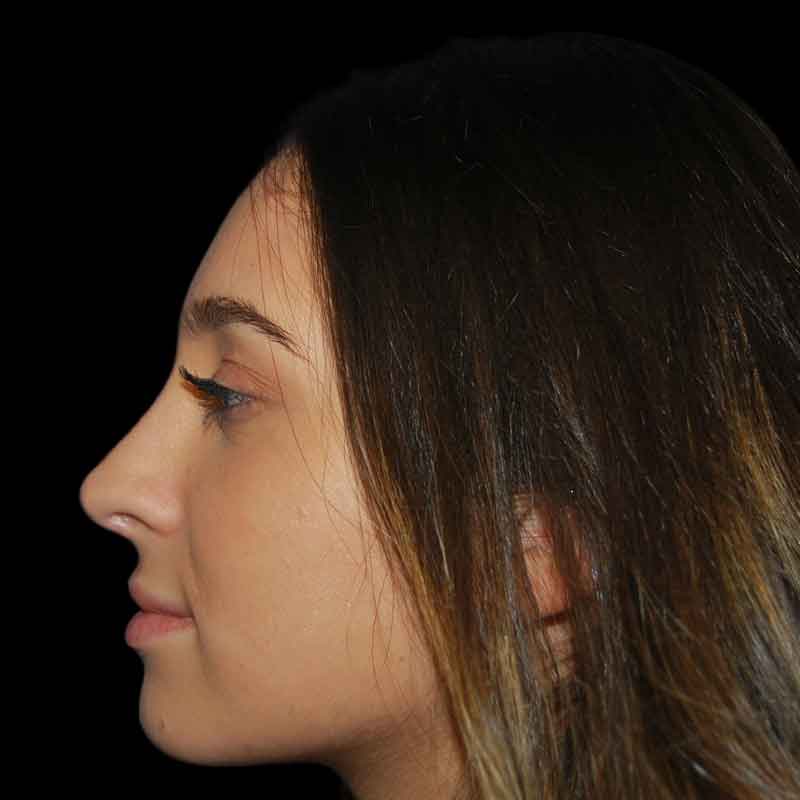 Rhinoplasty Before & After Patient #17023