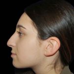 Rhinoplasty Before & After Patient #17023