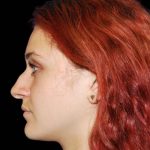 Rhinoplasty Before & After Patient #16874