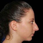 Rhinoplasty Before & After Patient #16879