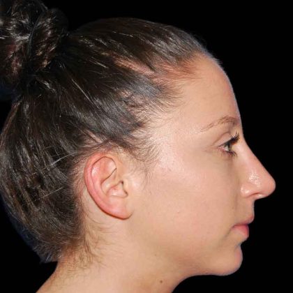 Rhinoplasty Before & After Patient #16879