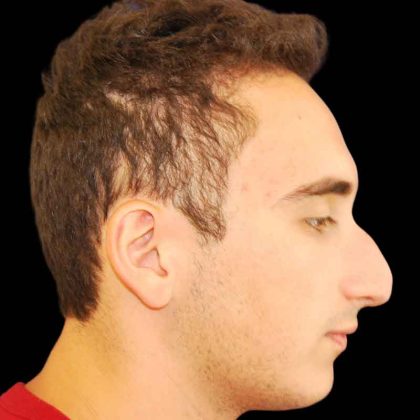 Rhinoplasty Before & After Patient #16885