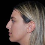 Rhinoplasty Before & After Patient #16892