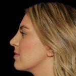 Rhinoplasty Before & After Patient #16892