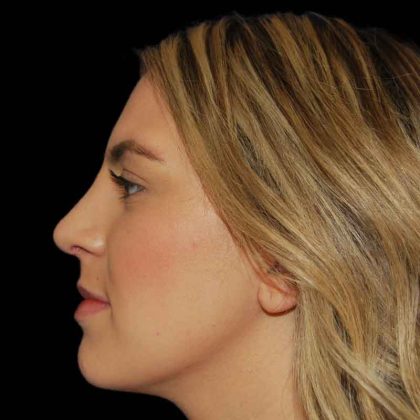 Rhinoplasty Before & After Patient #16892