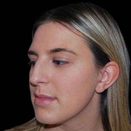 Rhinoplasty Before & After Patient #16892