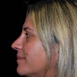 Rhinoplasty Before & After Patient #16899