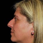 Rhinoplasty Before & After Patient #16899