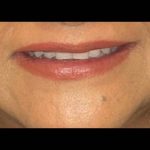 Lip Lift Before & After Patient #16778