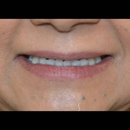 Lip Lift Before & After Patient #16778