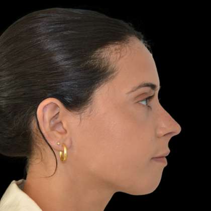 Rhinoplasty Before & After Patient #16864