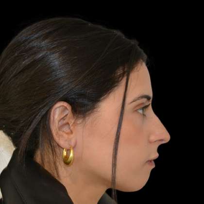 Rhinoplasty Before & After Patient #16864