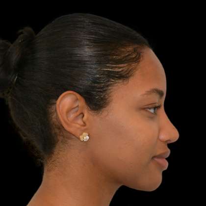 Rhinoplasty Before & After Patient #16857