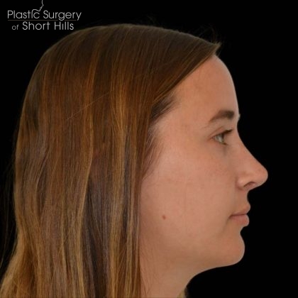 Facial Implants Before & After Patient #17079