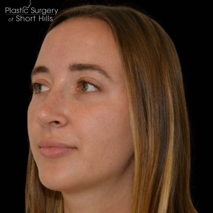 Facial Implants Before & After Patient #17079