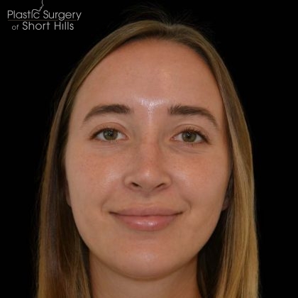 Facial Implants Before & After Patient #17079