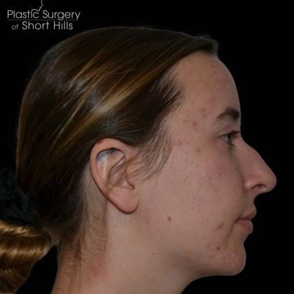 Facial Implants Before & After Patient #17079