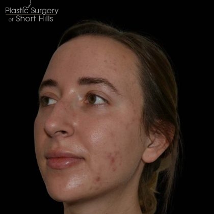 Facial Implants Before & After Patient #17079