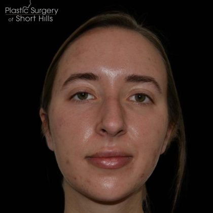 Facial Implants Before & After Patient #17079