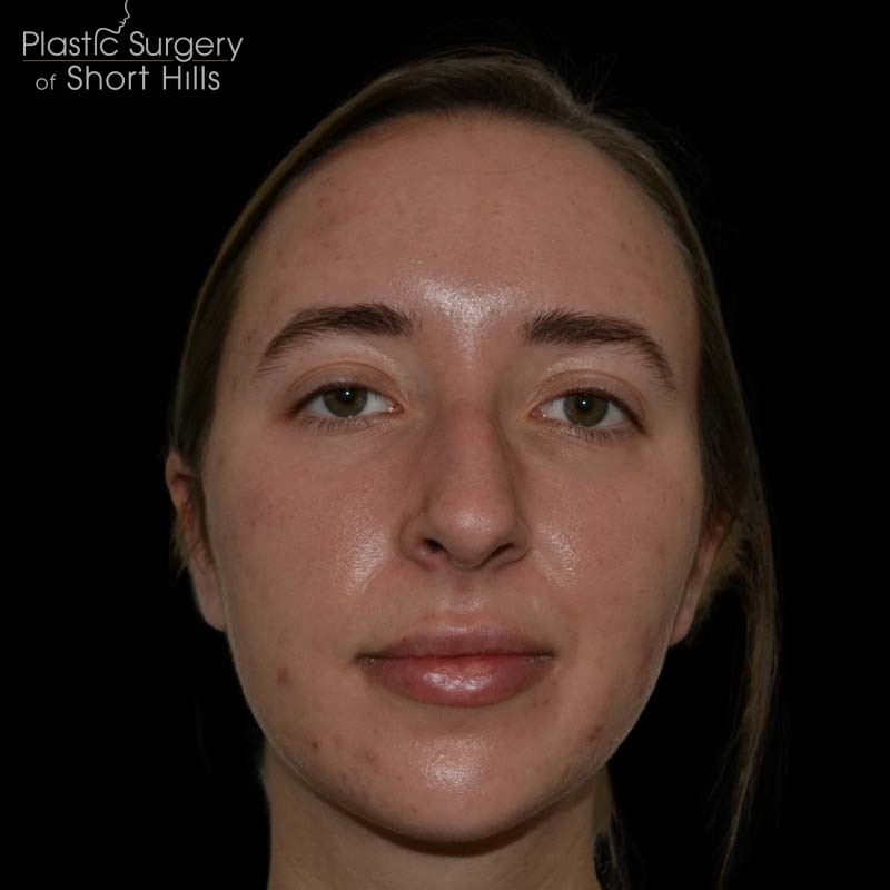 Facial Implants Before & After Patient #17079