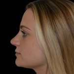 Rhinoplasty Before & After Patient #17063