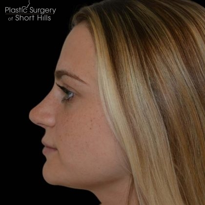 Rhinoplasty Before & After Patient #17063