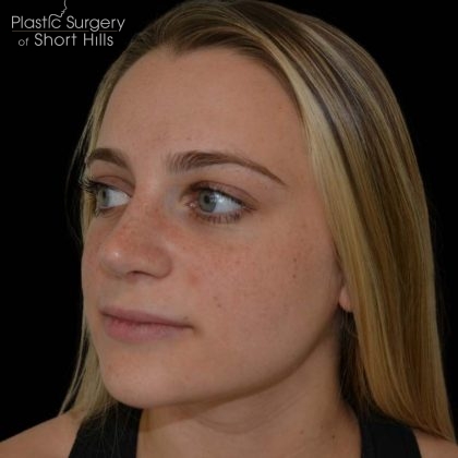 Rhinoplasty Before & After Patient #17063