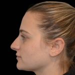 Rhinoplasty Before & After Patient #17063