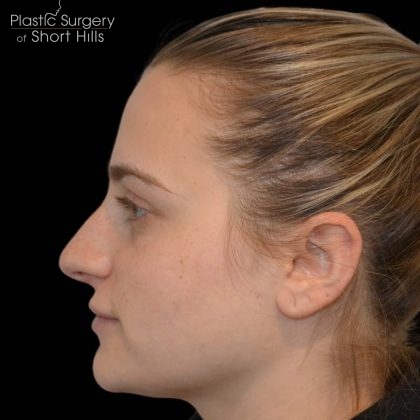 Rhinoplasty Before & After Patient #17063