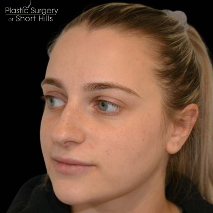 Rhinoplasty Before & After Patient #17063