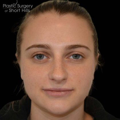 Rhinoplasty Before & After Patient #17063