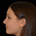 Rhinoplasty Before & After Patient #17110