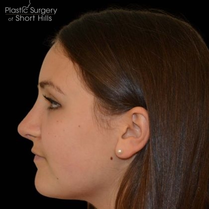 Rhinoplasty Before & After Patient #17110