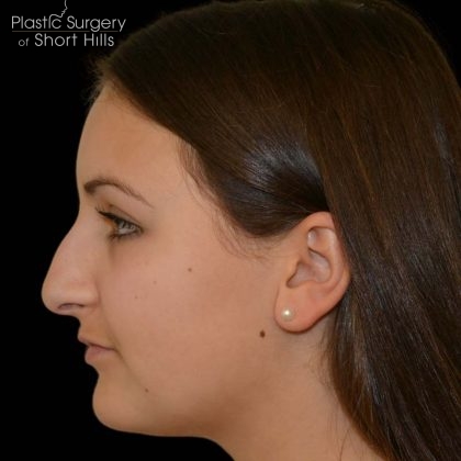 Rhinoplasty Before & After Patient #17110