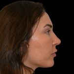 Rhinoplasty Before & After Patient #17100