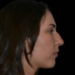 Rhinoplasty Before & After Patient #17100