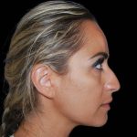 Rhinoplasty Before & After Patient #17093