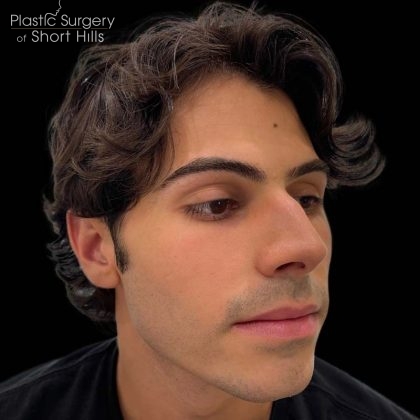 Liquid Rhinoplasty(Non-Surgical) Before & After Patient #17072