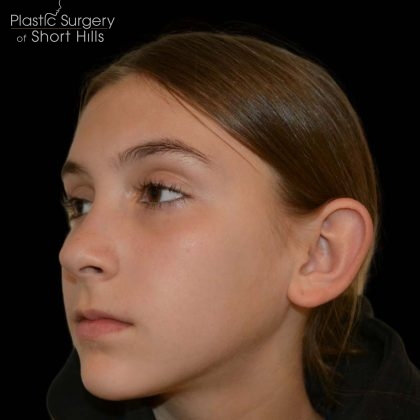 Otoplasty Before & After Patient #17056
