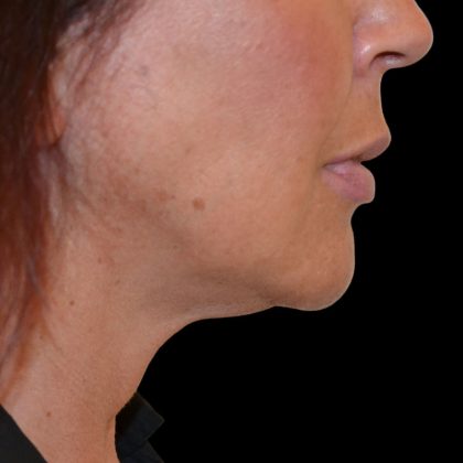 Liposuction-Face Before & After Patient #17287