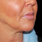 Liposuction-Face Before & After Patient #17287